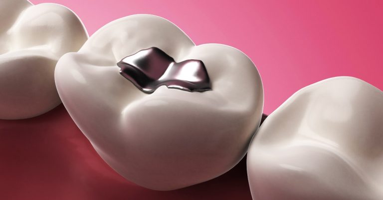 What Is Tooth Filling Types Of Filling And How Much Does Tooth Filling 